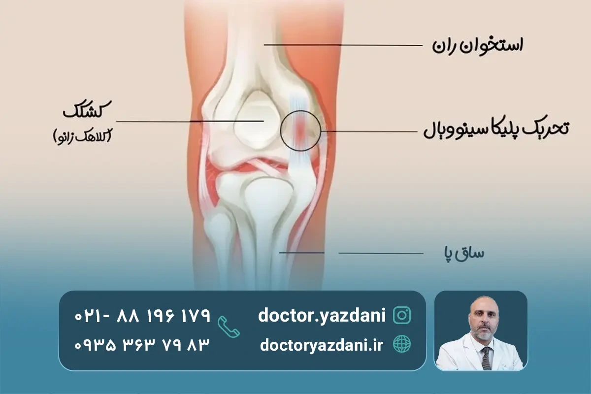 سندروم پلکانی